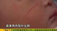 女子剖腹產(chǎn)女 嬰兒臉被手術(shù)刀劃破，醫(yī)院：怪孕婦肚皮太薄